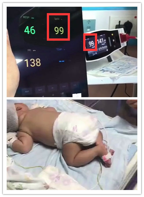 Neonatal spo2 sensor