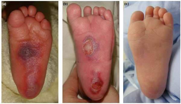 Long-term SpO2 monitoring will cause skin burn risk?